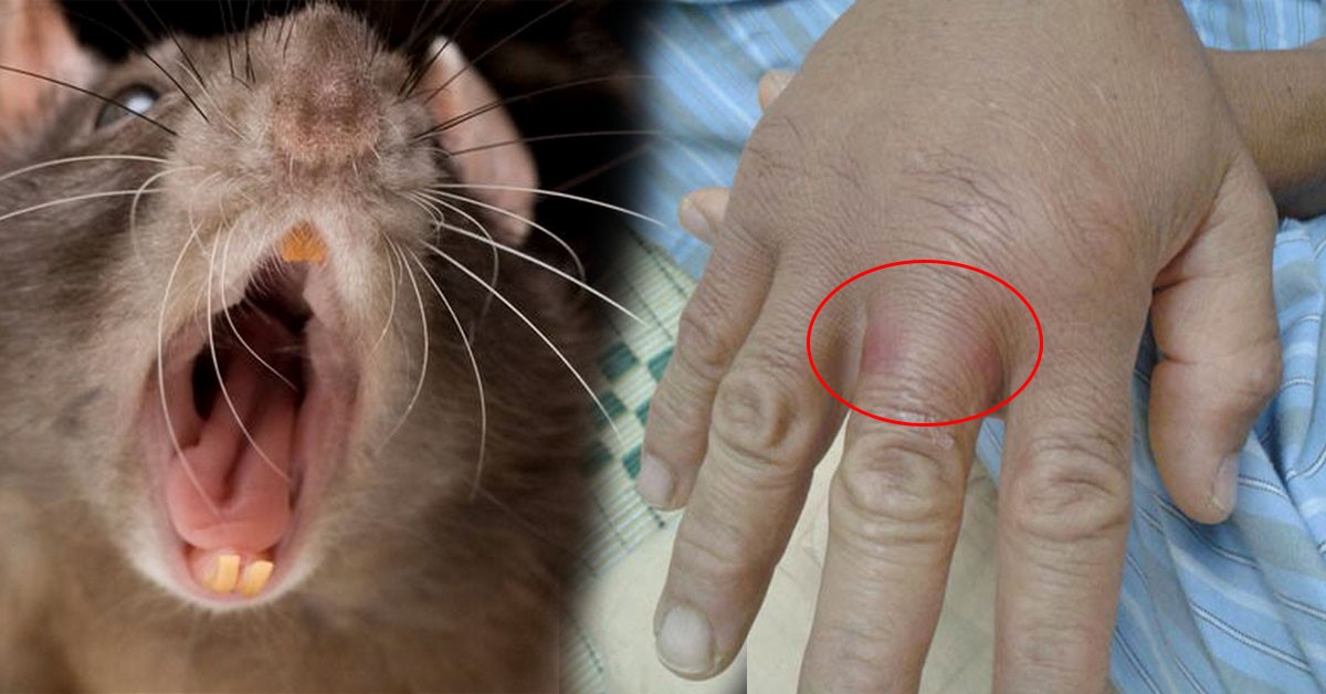 Bệnh sốt chuột cắn – một căn bệnh hiếm gặp